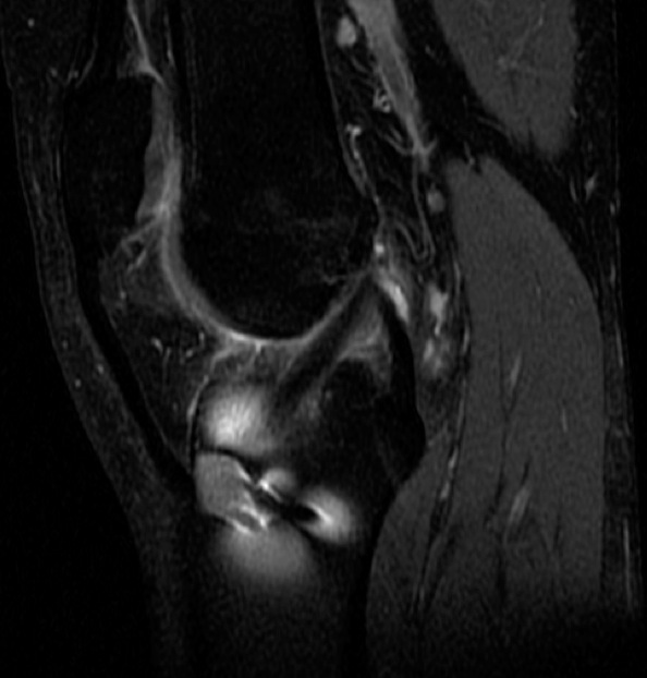 Figure 2 for case Normal ACL graft